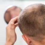 Metade dos homens convive com queda de cabelo aos 50 anos e maioria não trata